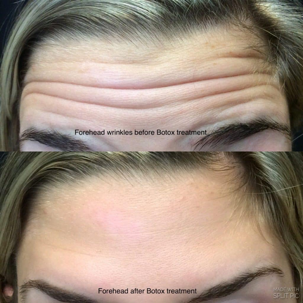 BOTOX at iLash Studio & Aesthetics in El Campo, TX