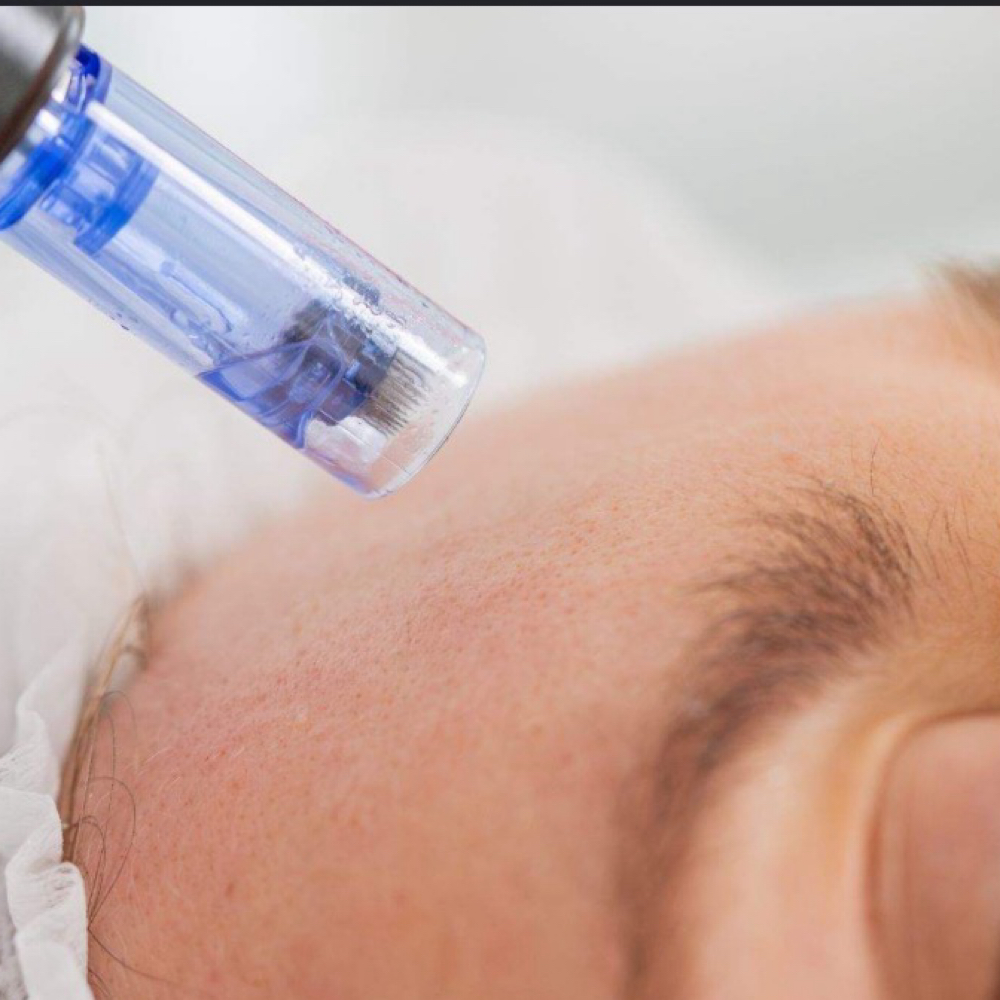 Microneeding at High Maintenance Massage & Esthetics LLC in Clyde, OH