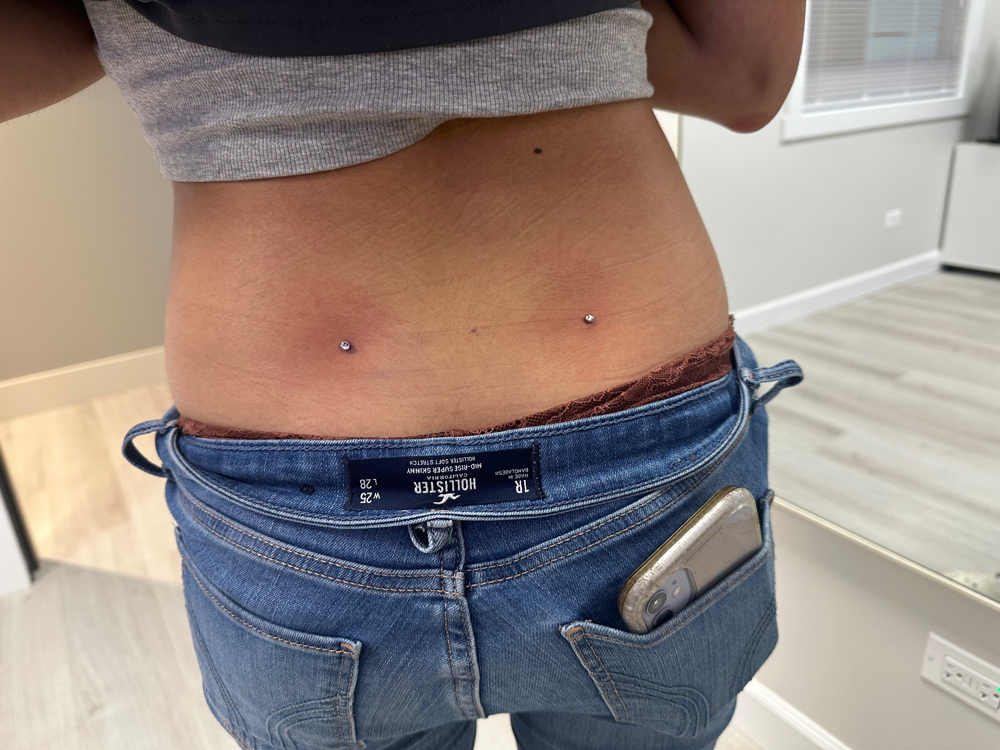 Back Dimple Dermals