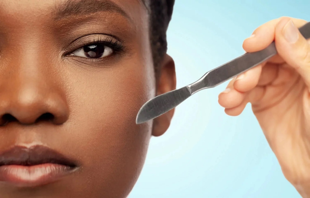 DERMAPLANING WITH CHEMICAL PEEL