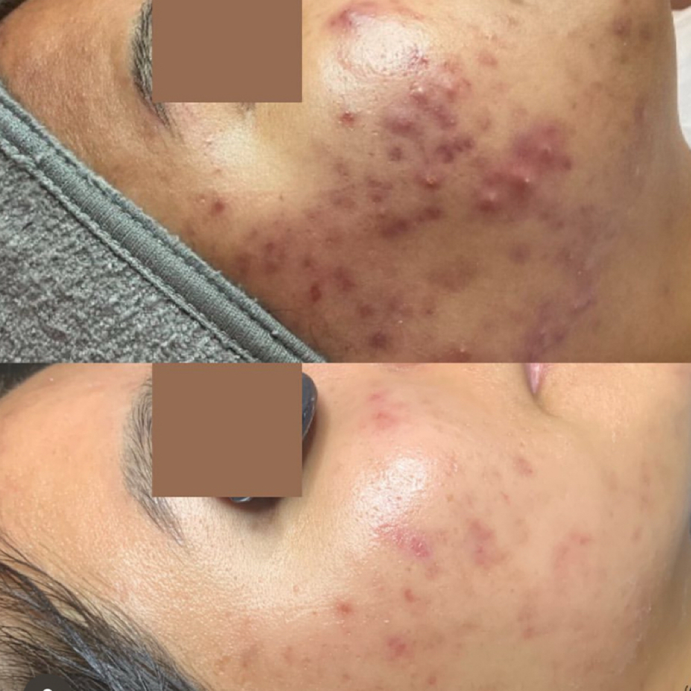 Acne Consultation at MySkin Aesthetics in Laredo, TX