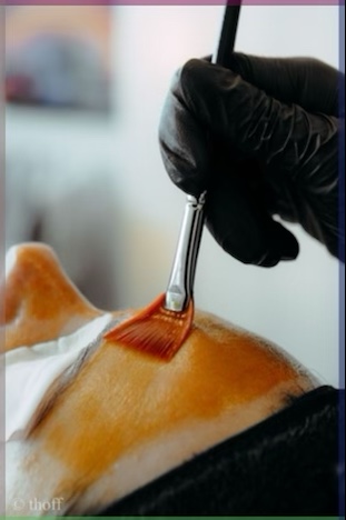 chemical Peel