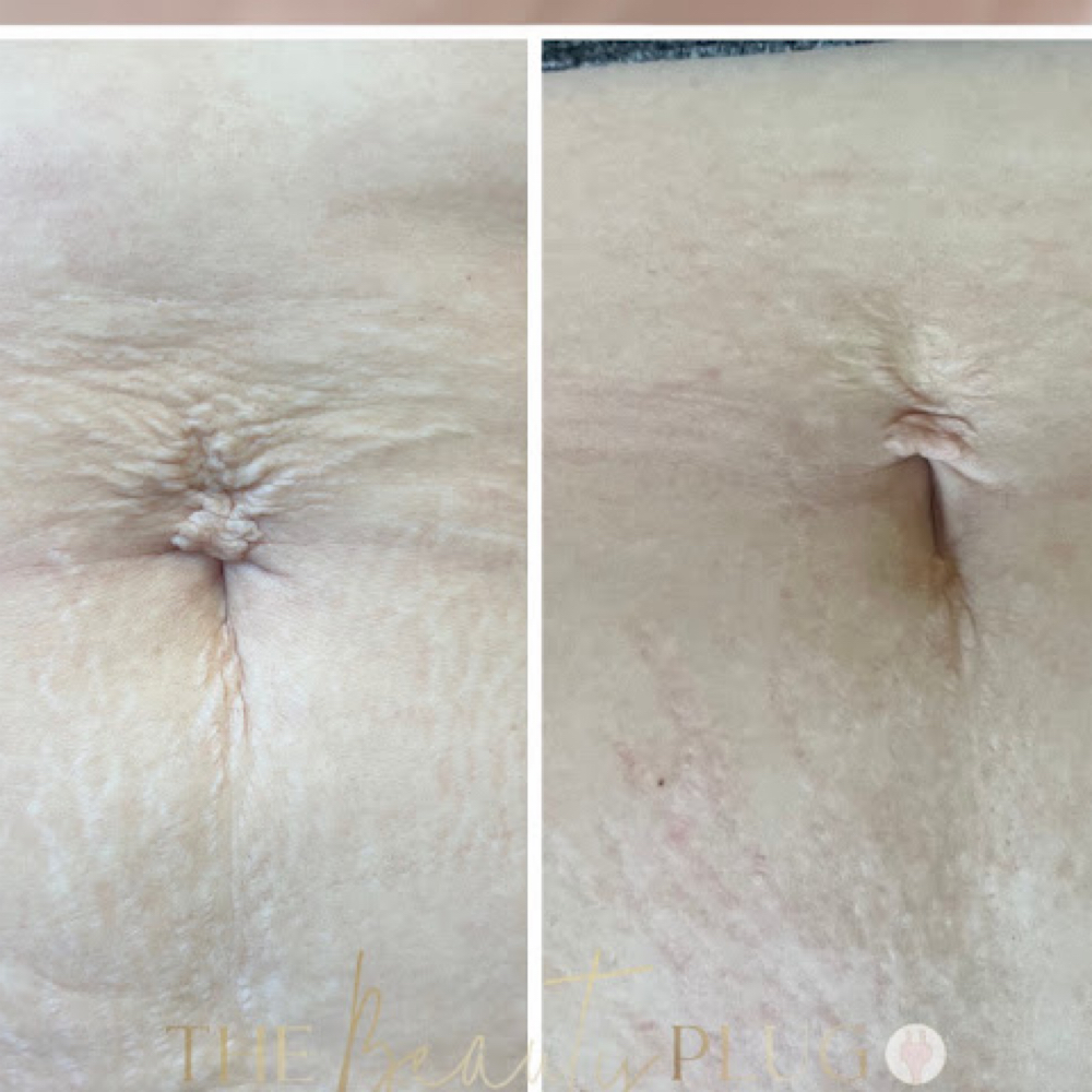 Inkless Stretch Mark Revision at The Skin Babe Company in Montclair, CA