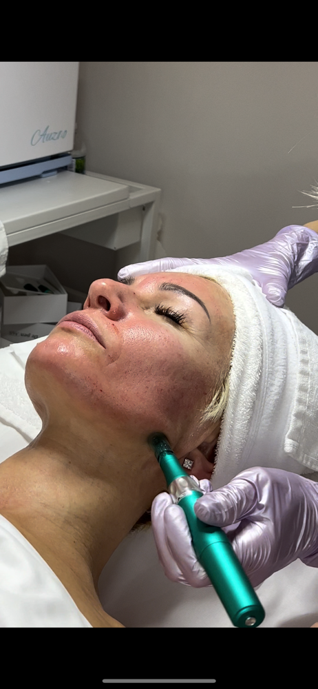 Fractional Mesotherapy