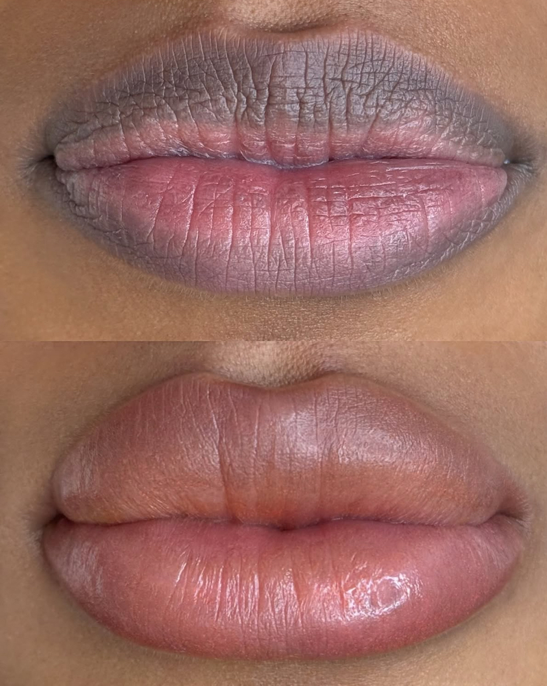 Dark Lips Neutralization