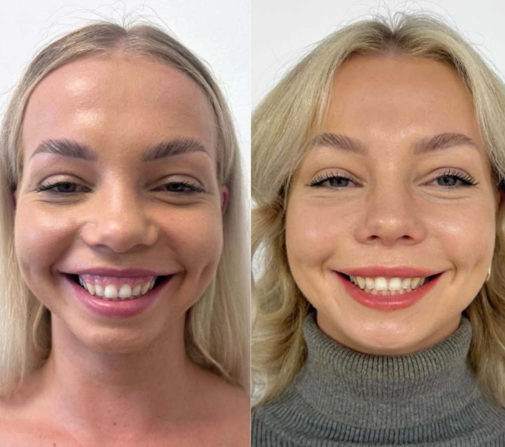 Gummy Smile Correction