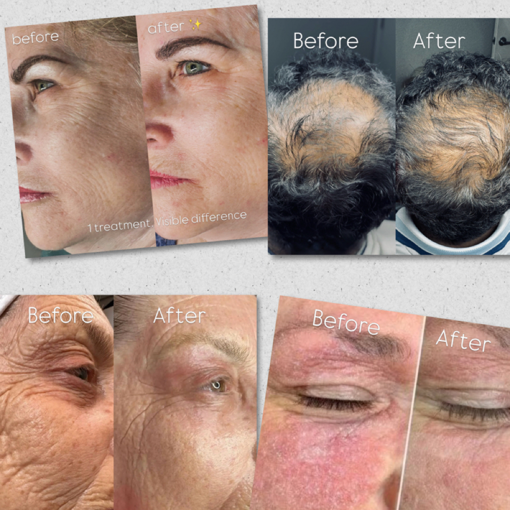 Full Face Warm Plasma 50% at Eszter Kiss Cosmetics in Deltona, FL