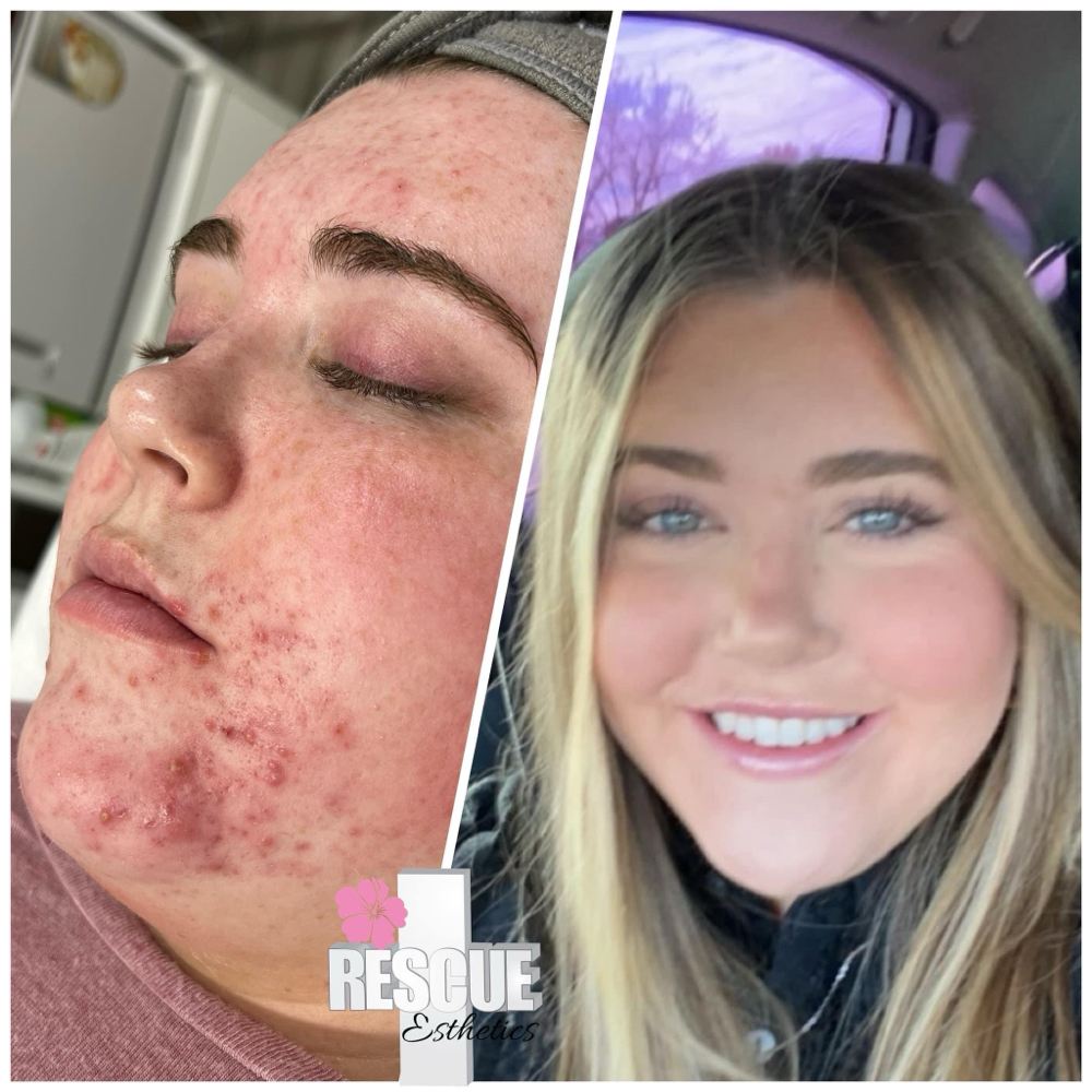 Acne Bootcamp Initial Consult