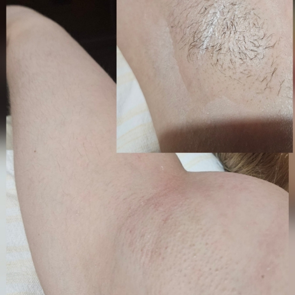 Underarm Sugaring at Andersen Esthetics LLC in Tonawanda, NY