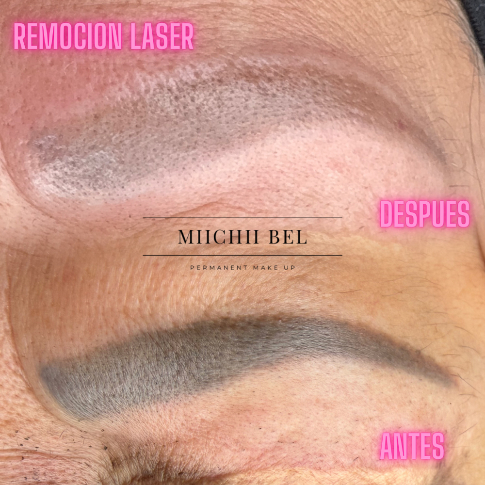 Laser Removal Tatto at Miichii Bel Brows in van nuys, CA