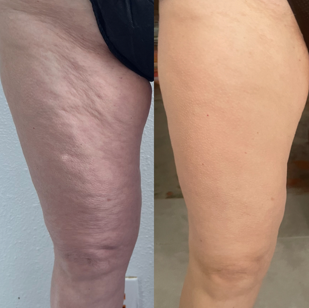 Leg Contouring