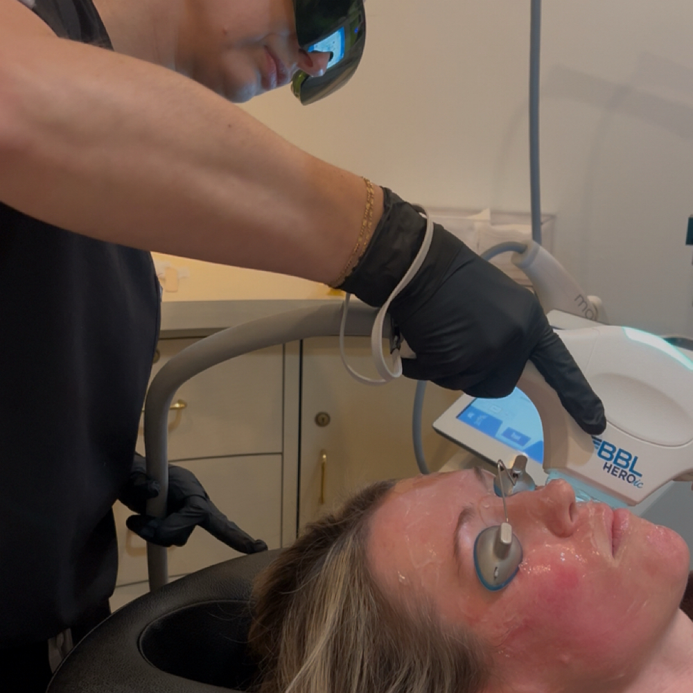 BBL HEROic (Face, Neck & Chest) at Your Body at Timeless Skin & Aesthetics in Bloomfield Hills, MI