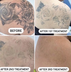 Large Tattoo Removal (1 Session)