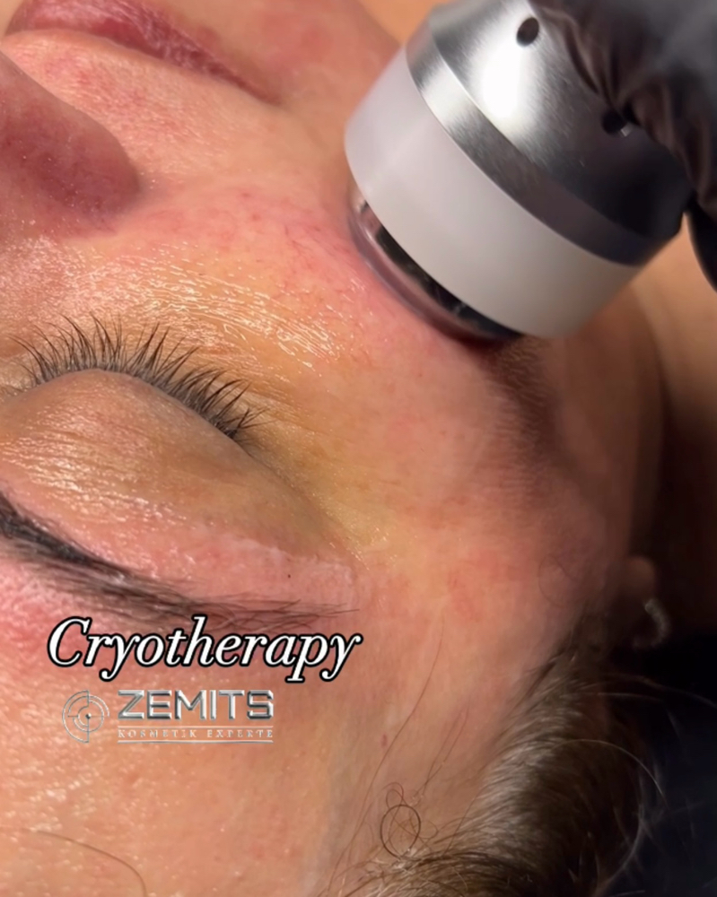 Dermaplane & Cryotherapy