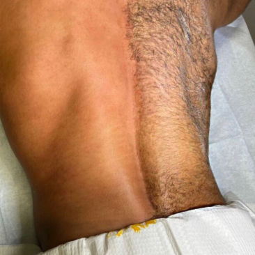 Upper Back at Hidden Beauty Wax & Spa in Arlington, TX