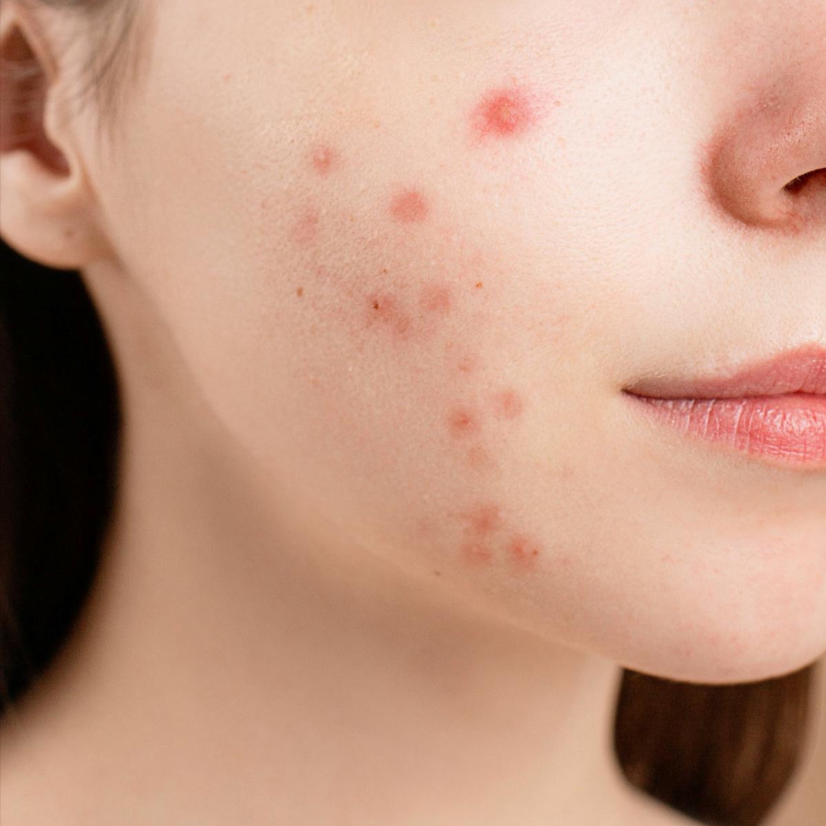 Acne Face/Body Therapy at Esthetics By Cindy in Naples, FL