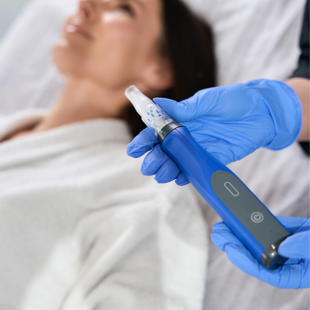 Microneedling with Salmon DNA at Luna Aesthetics in Alexandria, VA