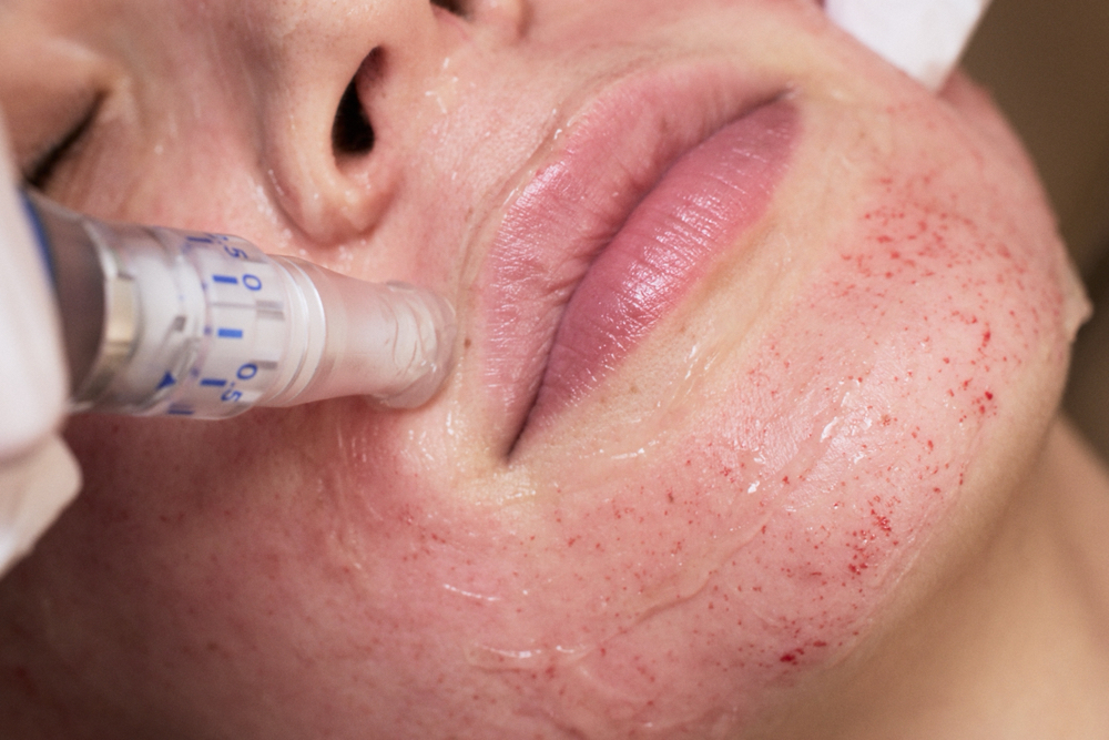 Serum Microneedling