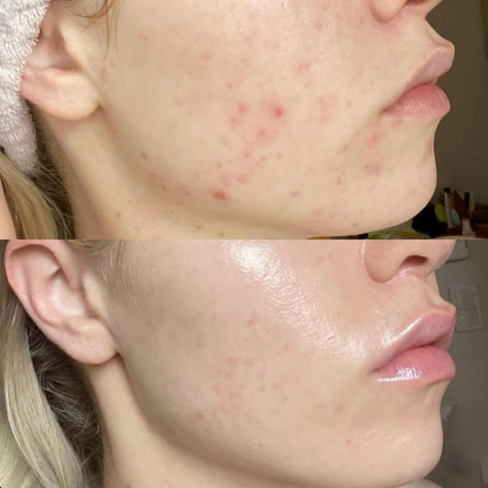 Crystal Clear | Acne Facial at Hoosier Beauties in Bloomington, IN