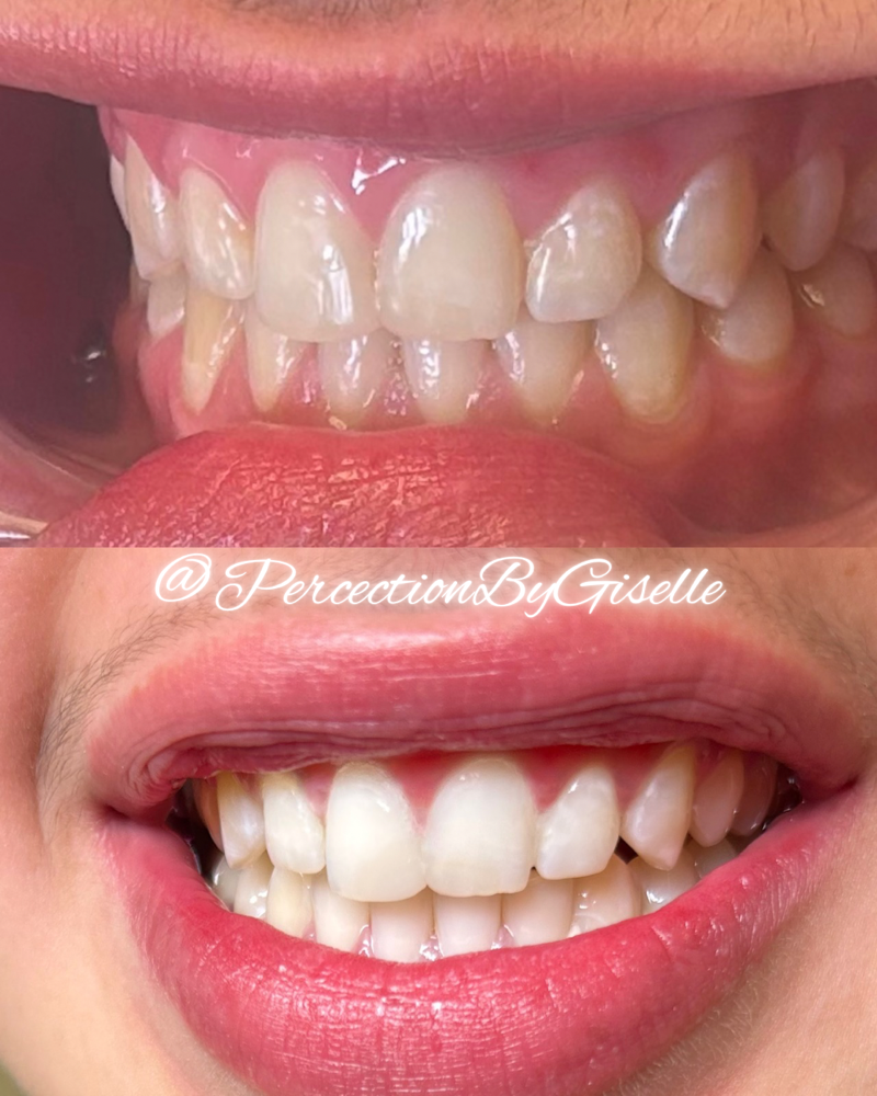 Teeth Whitening 20 Minute Session