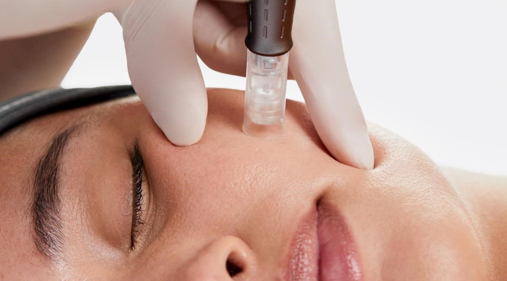 MICRONEEDLING FACIAL 90min