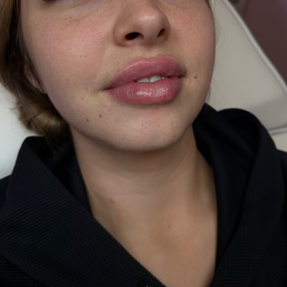 Lip Filler at Botox Babe in Houston, TX