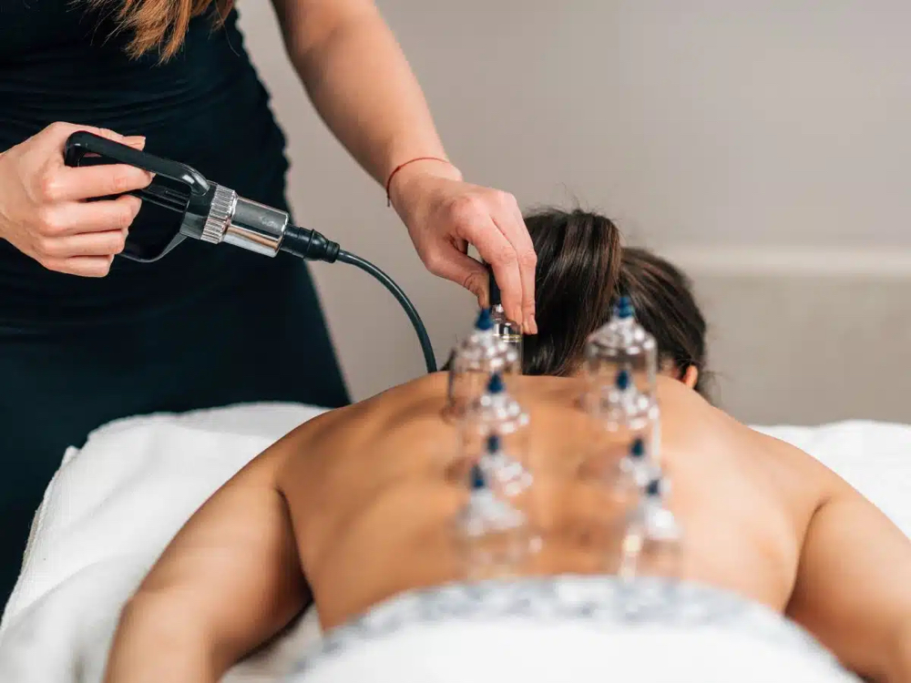 Cupping Therapy