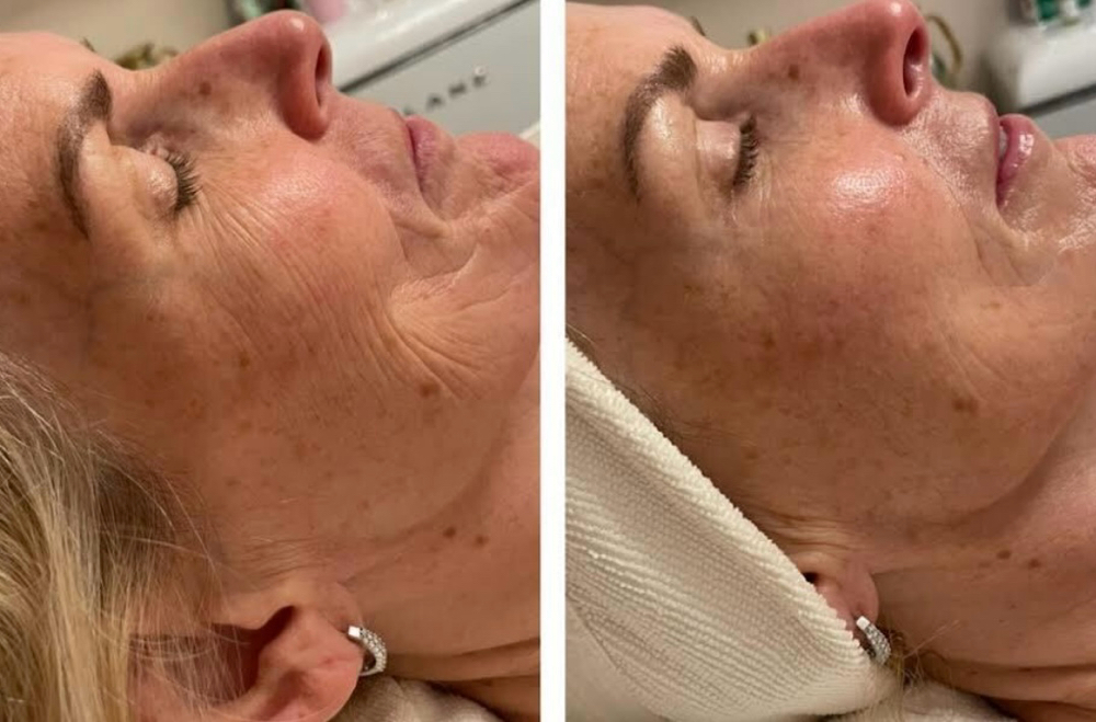 Anti-Aging Facial