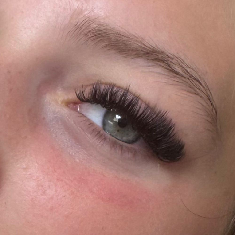 Volume Fill Options at Esthetic Glow in arlington, WA