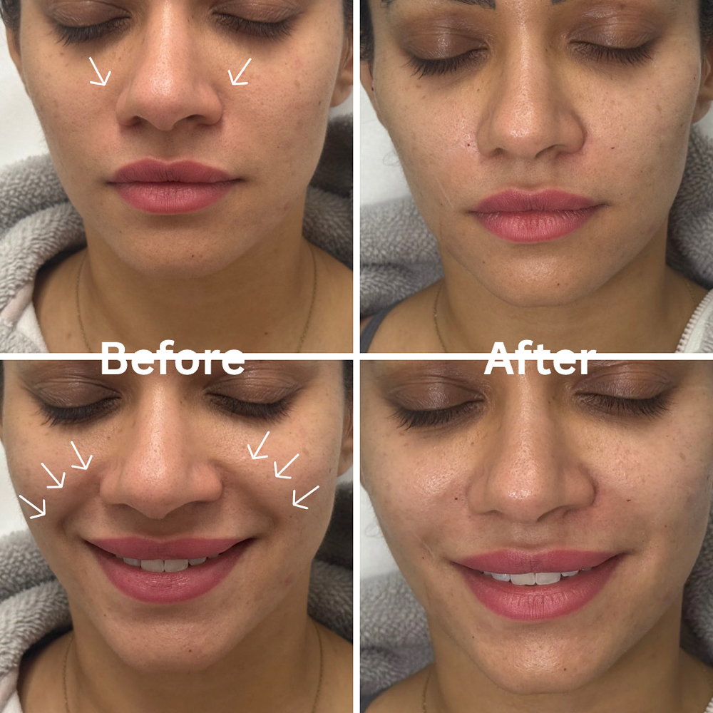 Nasolabial lines filler 1 ML