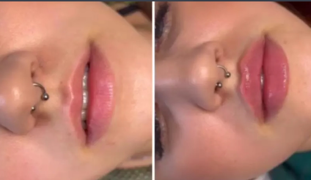 KISS ME LIP FILLER 1ml