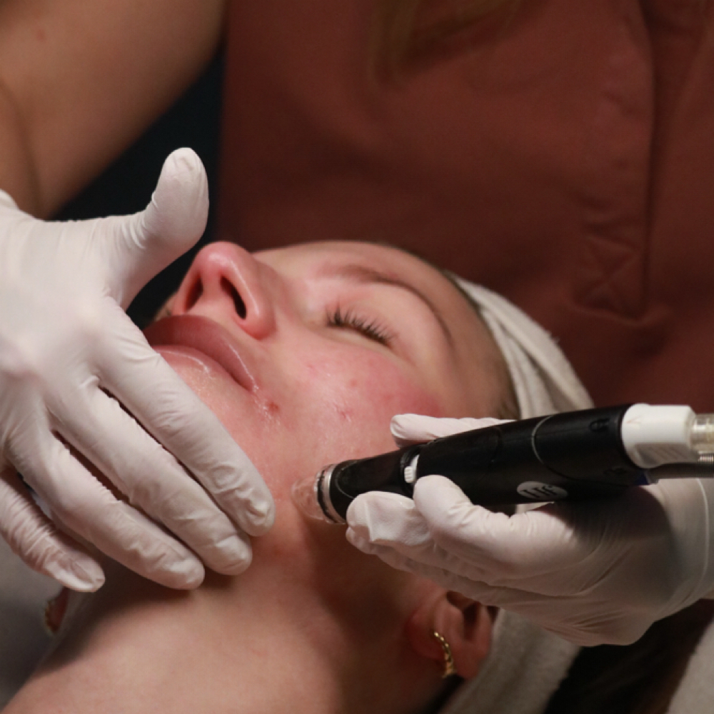 Microneedling (face & neck) at Mirror Mirror Aesthetics in Dunkirk, IN