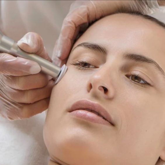 Microchanneling With A Peel at Brow Envy By Ruchi in Burlingame, CA