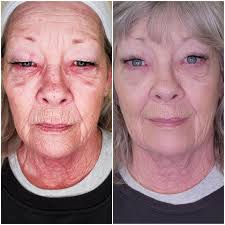 Body-Neveskin Facial