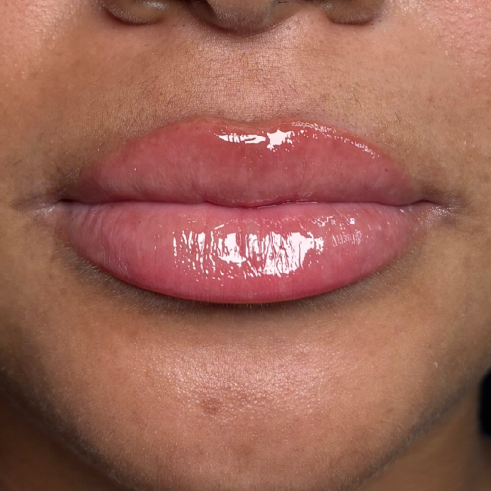 Lip Filler: Full Syringe at Luxry Aesthetics in Sherman, TX