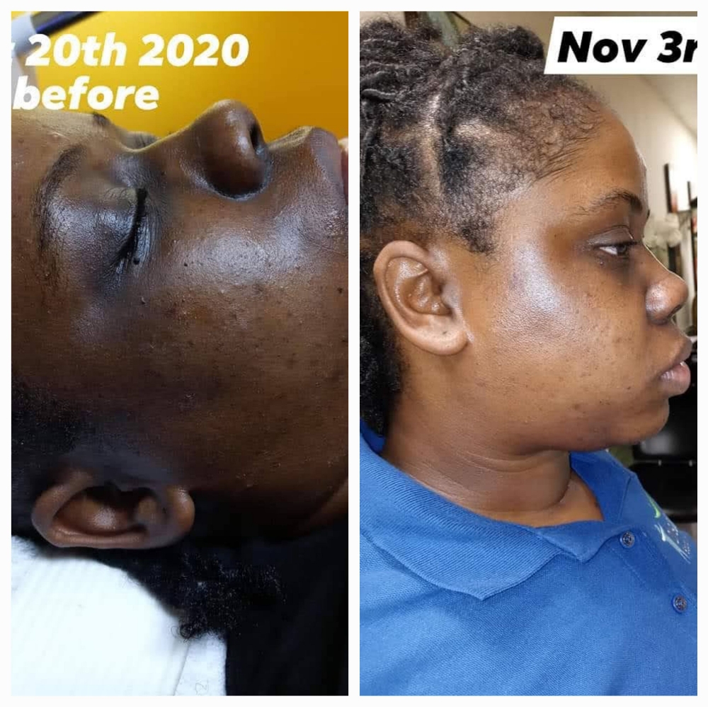 Chemical Peel ( Sensitive Skin)