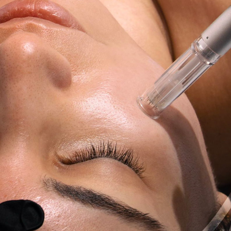 Microneedling Neck ONLY