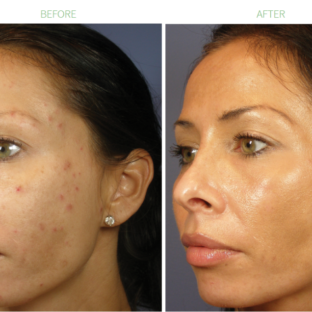 Chemical Peel at Bliss Beauty Bar in Houston, TX