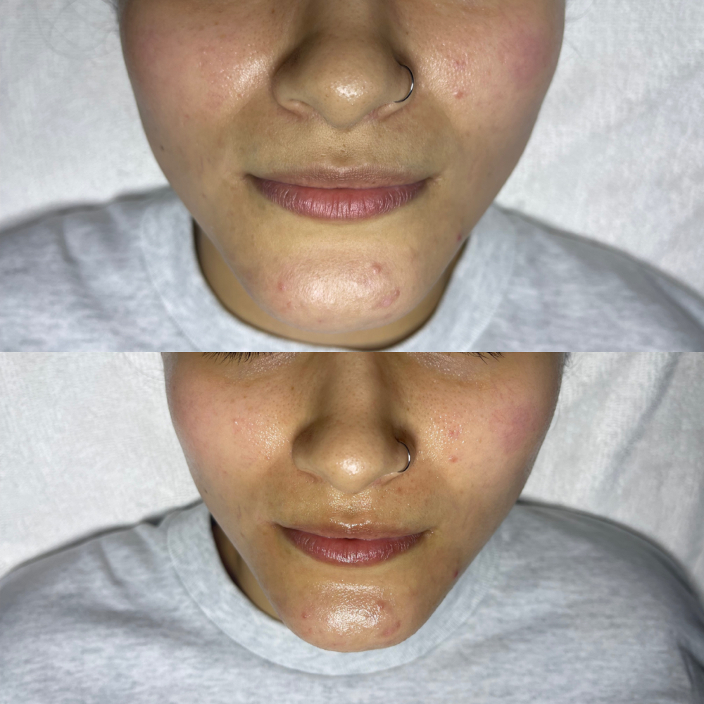 Microneedle Facial at Bella By Magali in Rogers, AR