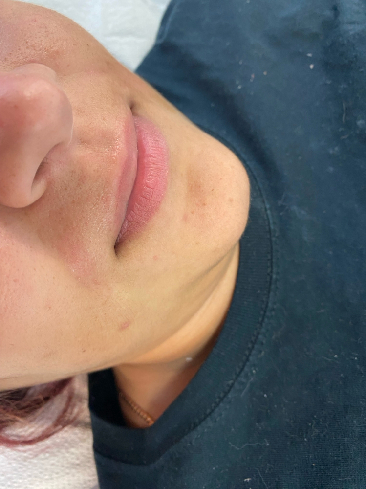 Lip And Chin