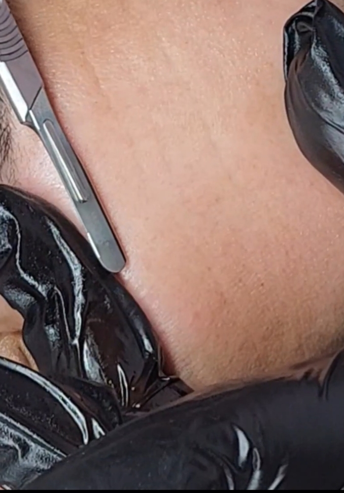 Dermaplane