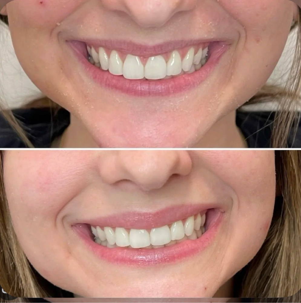 Lip Flip at Flawless Spa & Beauty in Fort Worth, TX