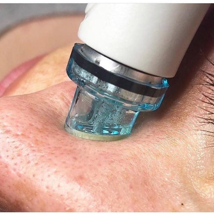 Hydro-Dermabrasion Facial