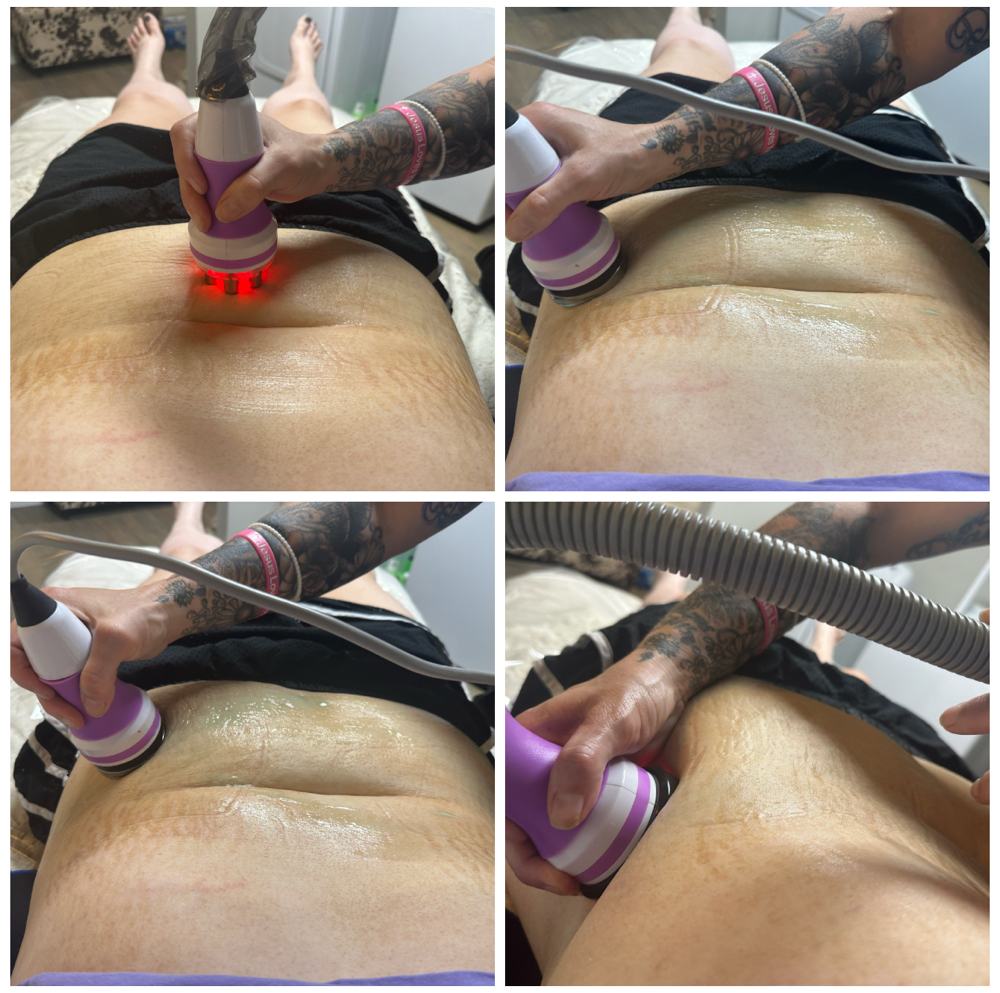 Body Contouring 3 Sessions at SimplySallyAesthetics in Olive Branch, MS