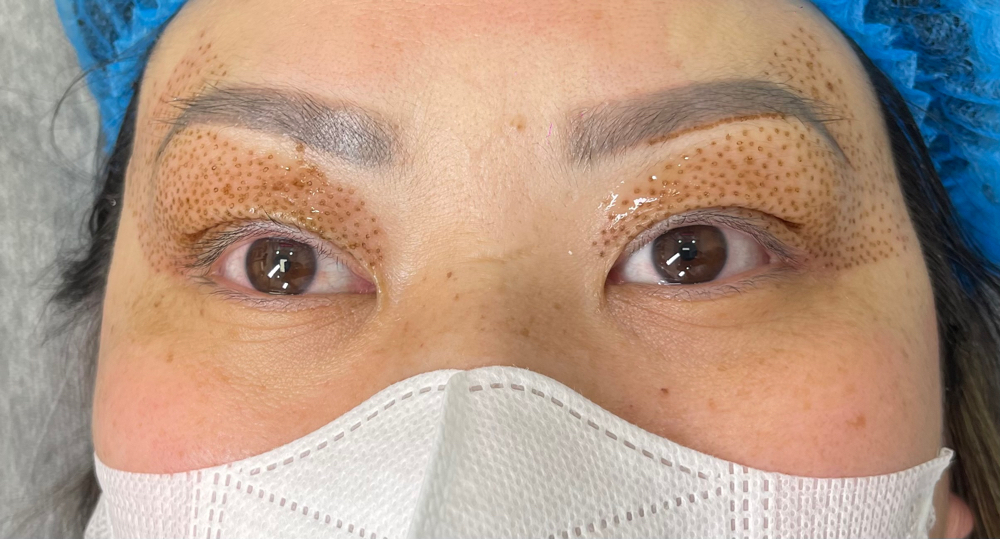 Combo Upper And Under Eyelids Reju