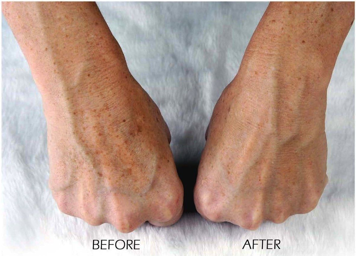 Body Microdermabrasion