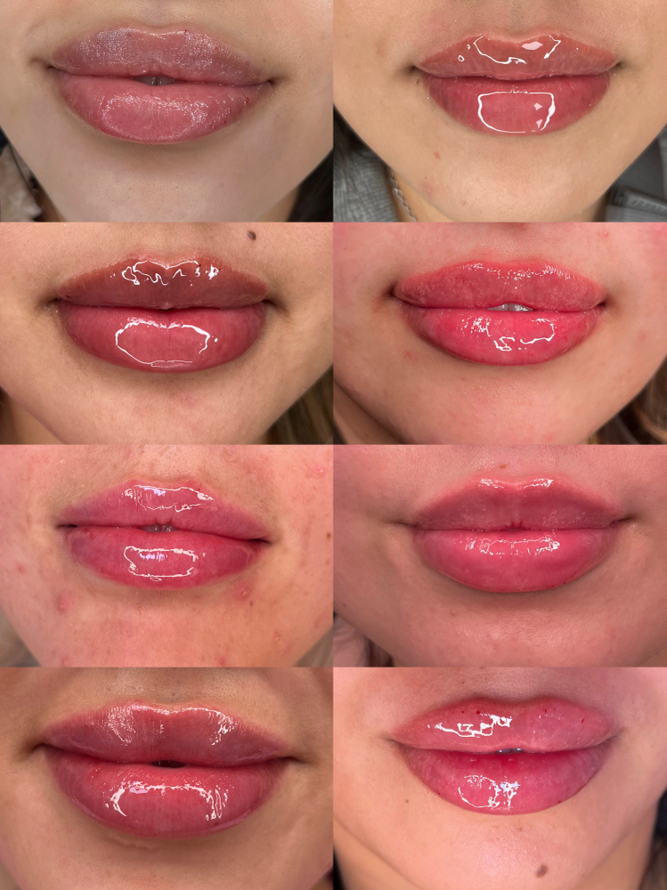 Full Syringe Lip