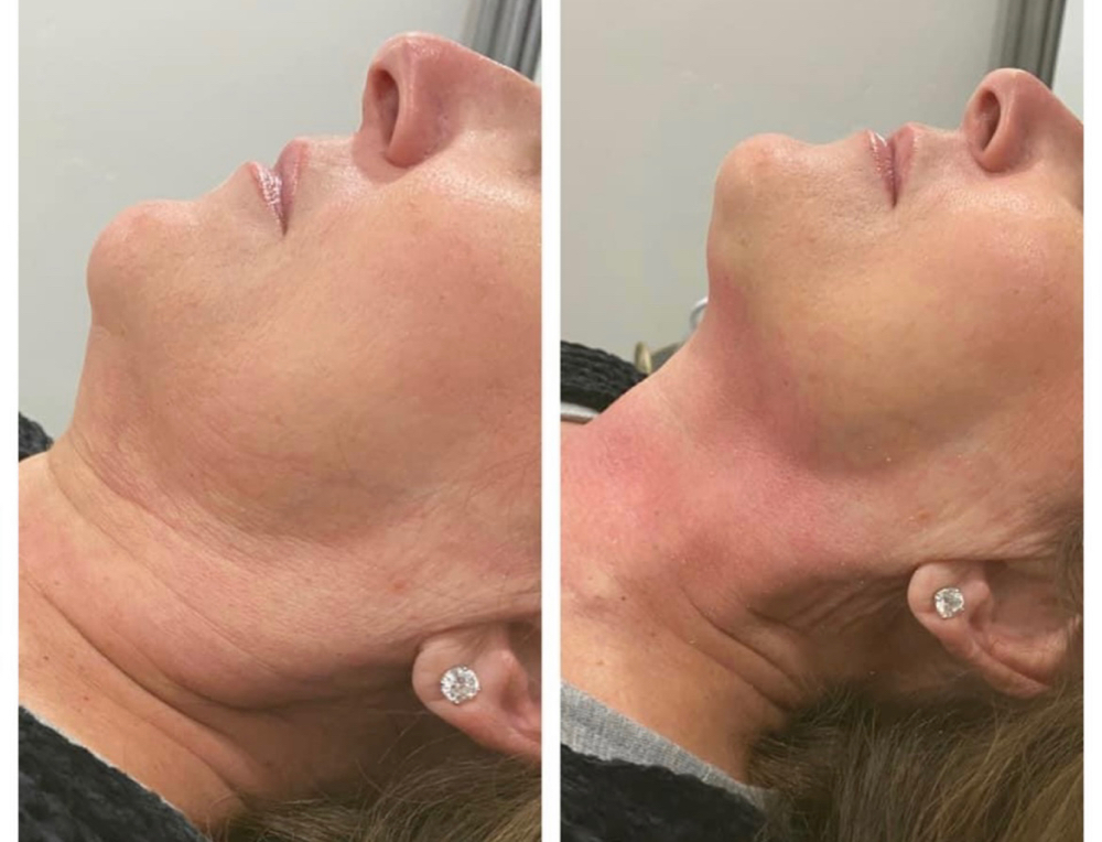 Jawline, Under Chin Area & Neck