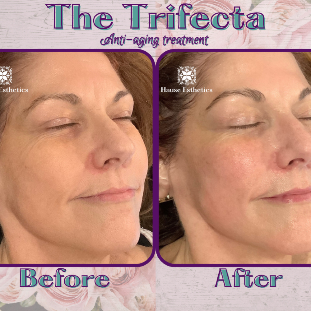The Trifecta at Hause Esthetics in Morristown, TN