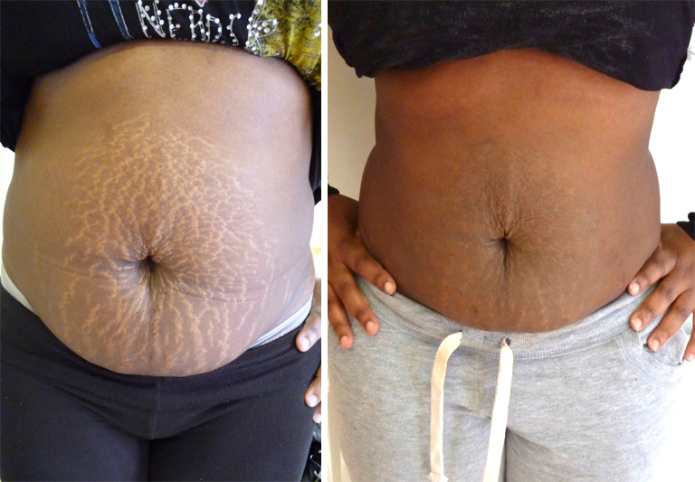 Stretchmark Camouflage